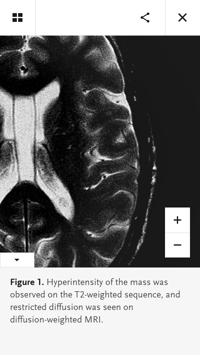 New England Journal Of Medicine — AREA 17